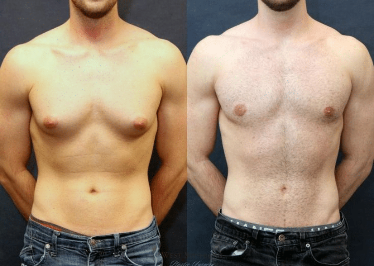 Gynecomastia Self-Care