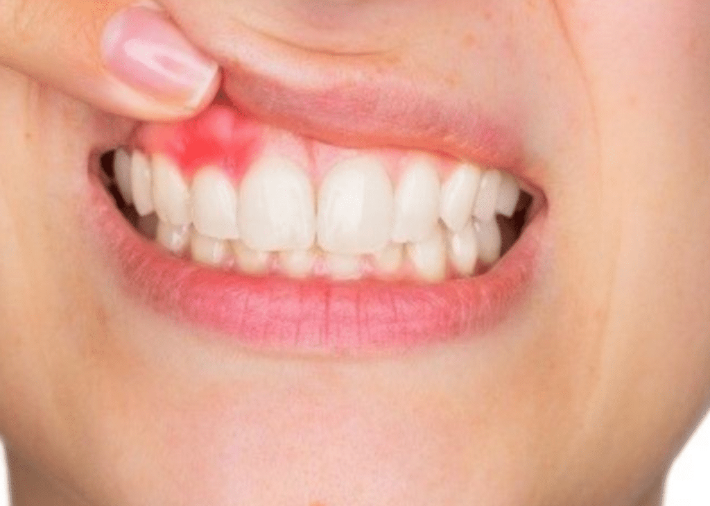 Gingivitis Self-Care